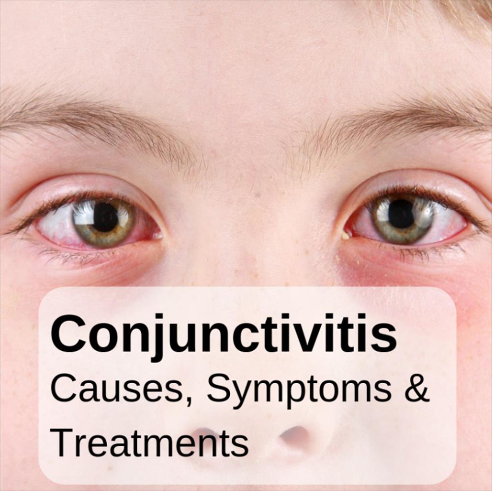 Conjunctivitis: A Comprehensive Guide to Pink Eye 